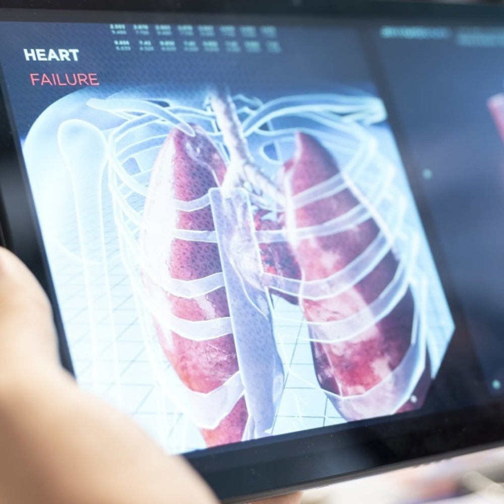 Câncer de pulmão: rastreamento por tomografia reduz sua mortalidade