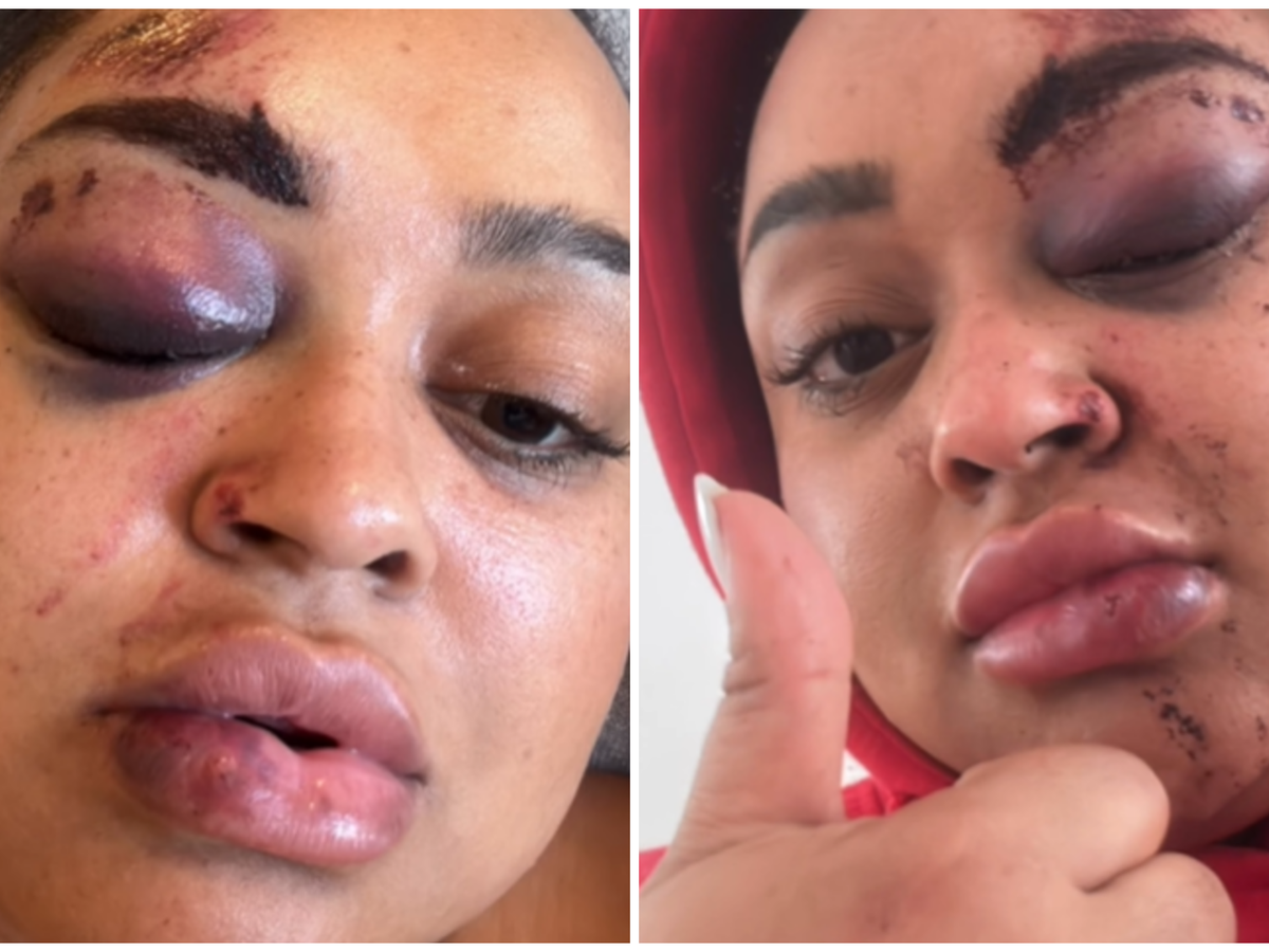 Ex-BBB Rízia Cerqueira sofre acidente com moto elétrica e mostra ferimentos: 'Fiquei arrebentada'