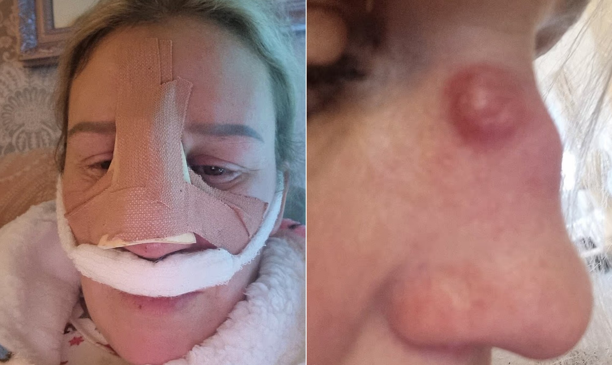 Entenda como sangramento após mergulho levou mulher a descobrir câncer raro no nariz