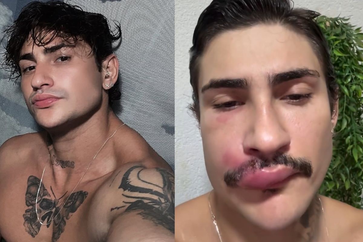 Ken: influencer é internado com infecção após espremer espinha na boca