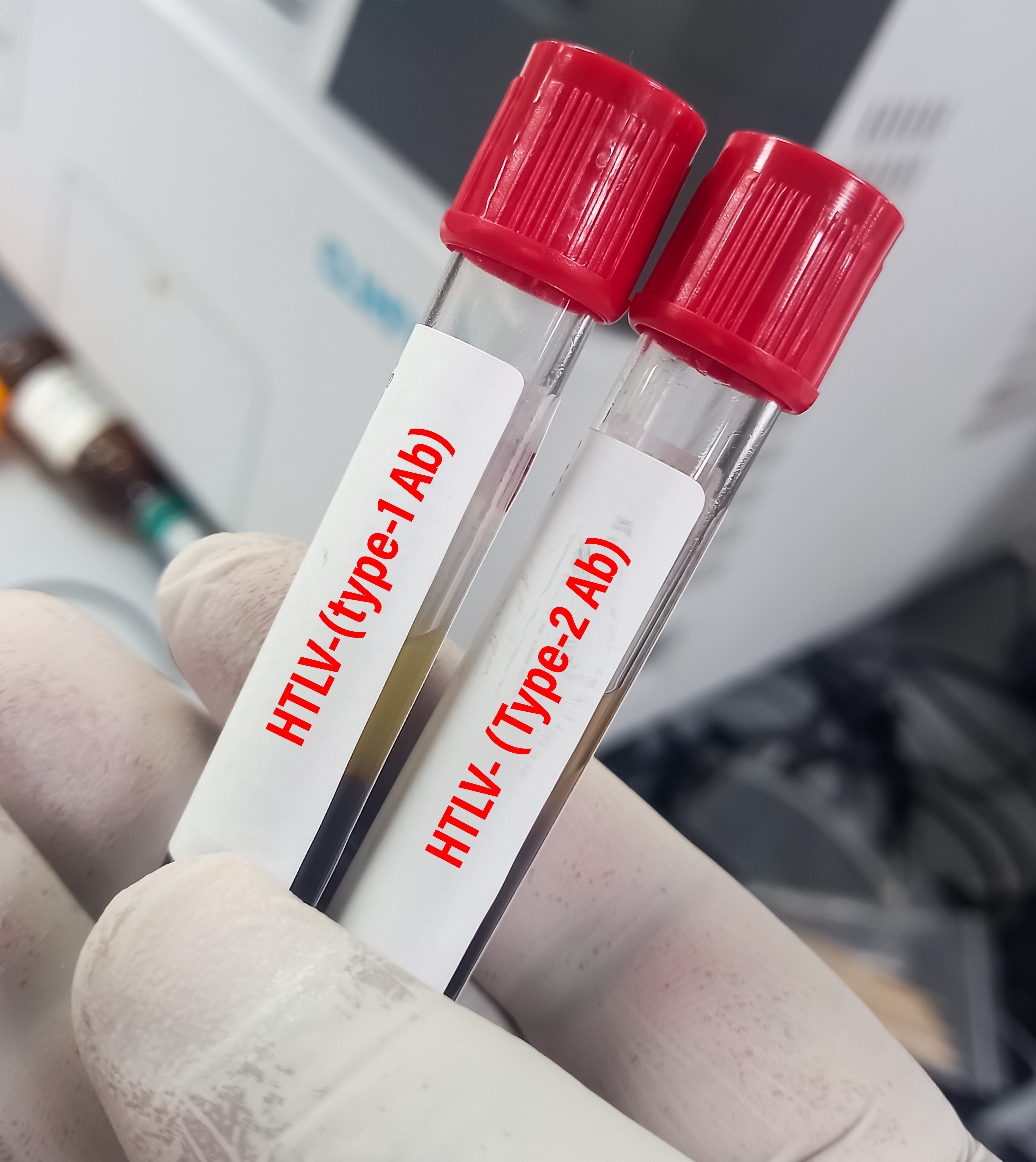 Esclerose múltipla progressiva: estudo da Fiocruz usa vírus HTLV-1